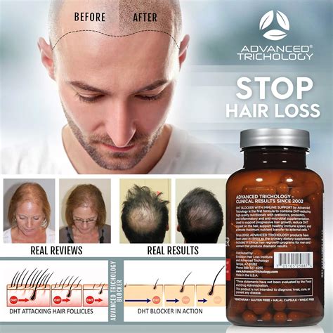 dht blockers for hair growth.